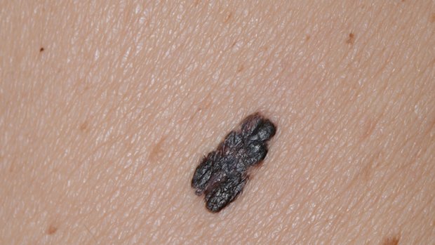 About two in three Australians will be diagnosed with skin cancer by the time they hit 70.
