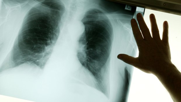 The government has committed to tackling Australia's occupational lung disease crisis.