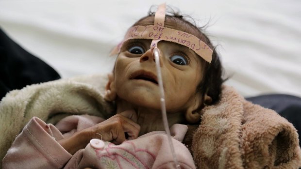 Udai Faisal died on March 24 of acute malnutrition at al-Sabeen Hospital in Sanaa, Yemen. 