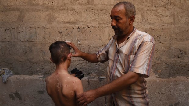 Nadhm Hamid shows the scars on his 11-year-old son Yaser caused by a chemical weapon that came through the roof of his home in Mosul.