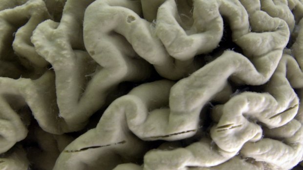 A section of a human brain with Alzheimer's disease is on display at the Museum of Neuroanatomy at the University at Buffalo, in Buffalo, New York.