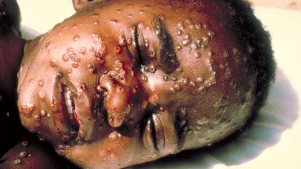 Facial lesions are seen on a boy suffering from smallpox.
