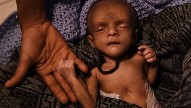 Laila Begum holds her malnourished son Mohammed Ifran's hand as he receives treatment at the Red Cross Field Hospital in Kutupalong.