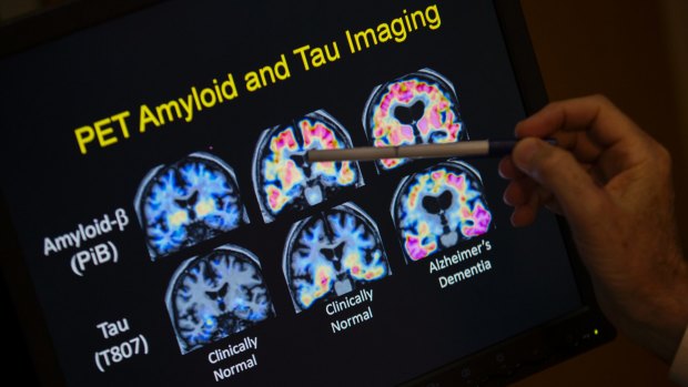 PET scan results from a study on brain function in Alzheimer's disease at Georgetown University Hospital in Washington.  