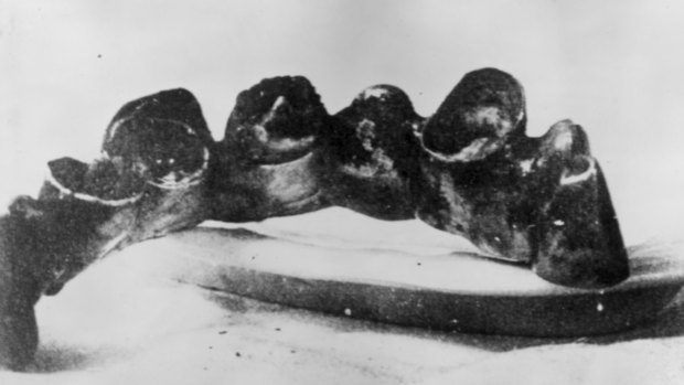 A section of Hitler's front teeth.