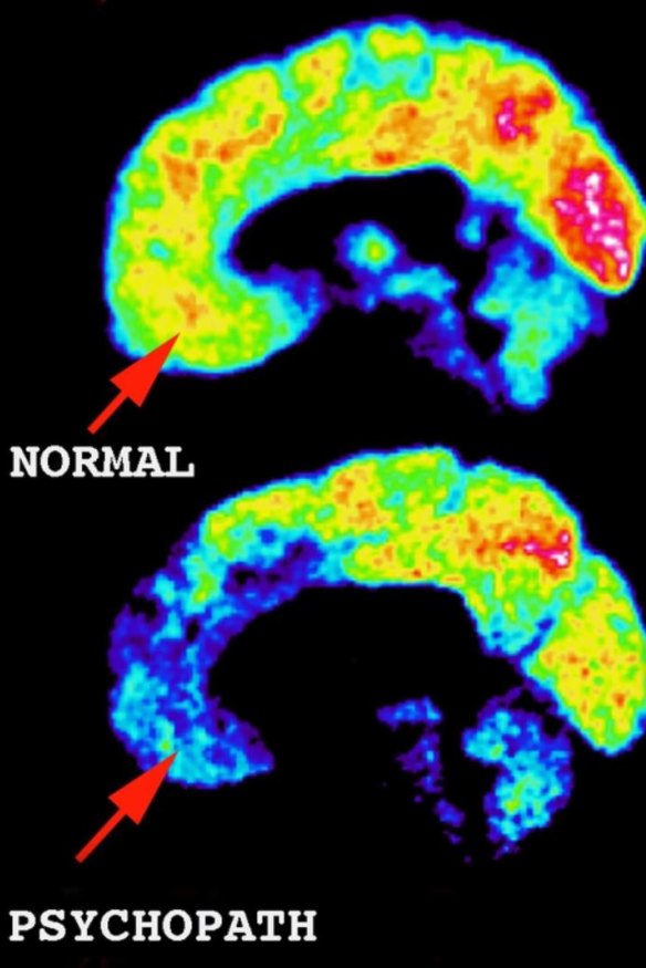 PET scans of a psychopath show areas of decreased brain activity in the social and emotional centre compared to a normal adult.