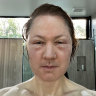Millionaire injects himself in attempt to ‘age backwards’. His face then ‘blows up’