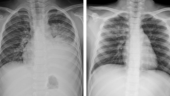 Collection of radiographs show the effects of mycoplasma pneumoniae on the lungs of children. Source: Cho et al (2019)