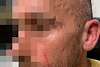 Mental health nurse James told nine.com.au he was attacked by a patient who tried to gouge his eyes out.