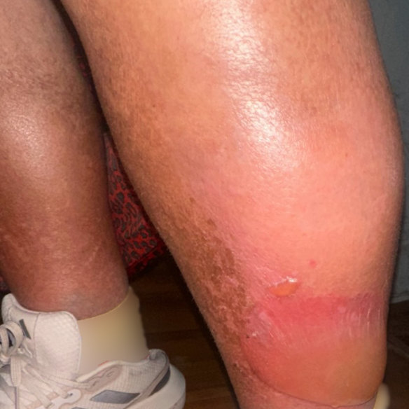 A large blister appeared on Carol’s swollen leg after a fall in a Sydney group home operated by Beyond Care.