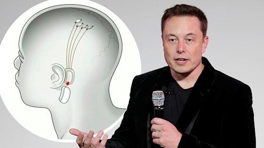 Elon Musk Neuralinks. 