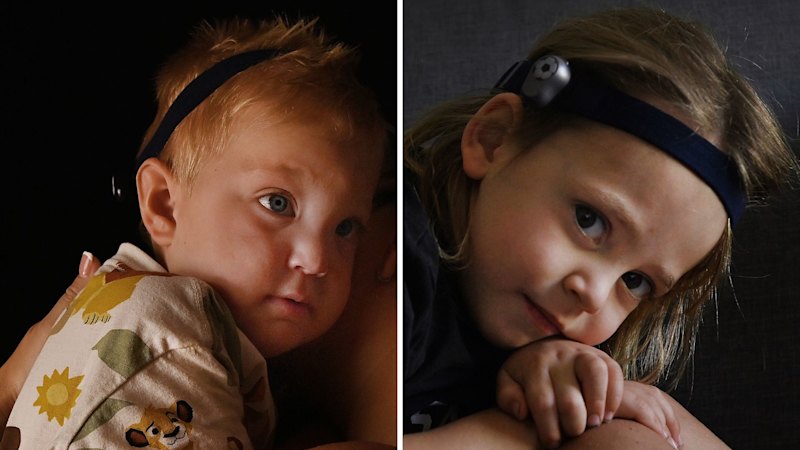 The children waiting years for a 15-minute procedure