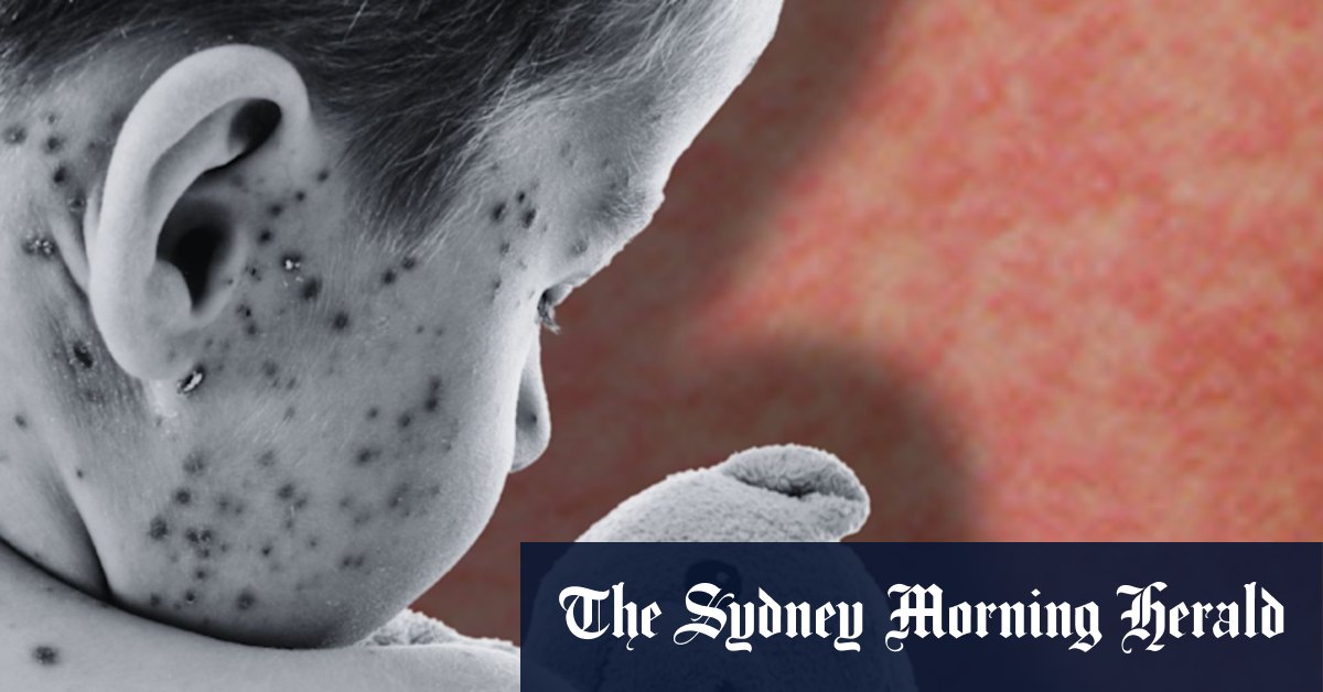 State has increase in measles cases in 2025