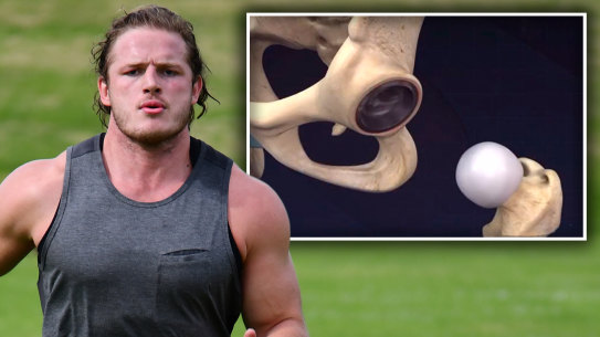 George Burgess is back in the NRL after undergoing hip resurfacing surgery.