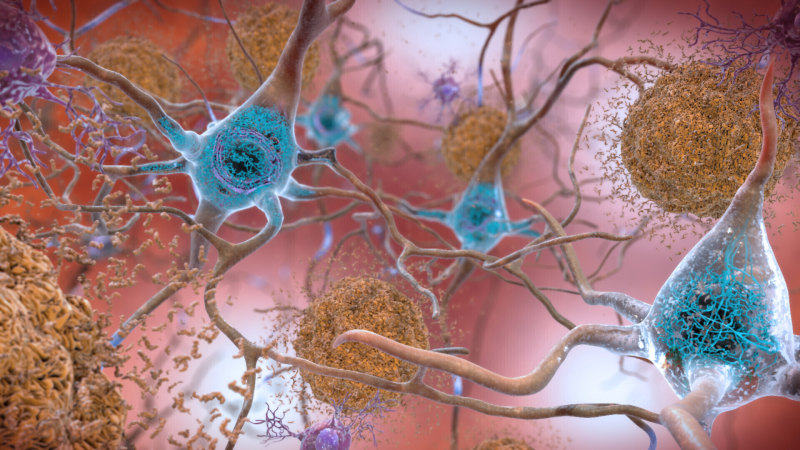 ABD, hastalığı mütevazı bir şekilde yavaşlatan Alzheimer ilacını onayladı