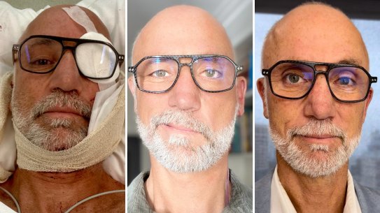 Composite image of Graham Kittle before, during and after his facial reconstruction following a surfing incident. 