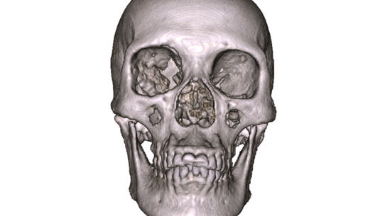 The identification of skulls is difficult and prone to error.