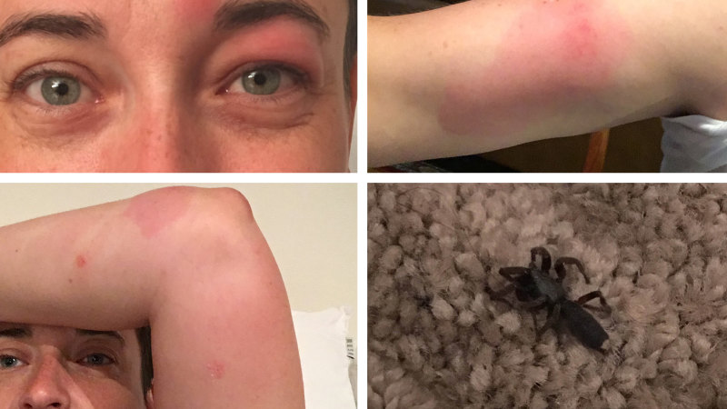 A White Tail Spider Bit Me Seven Times While I Was Asleep