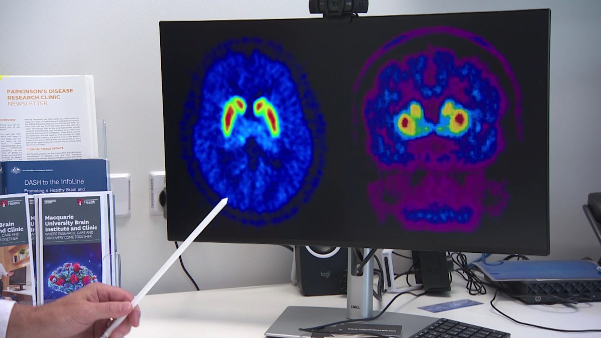 Australian trial offers hope in preventing Parkinson’s disease