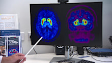 The drug has potential to reduce inflammation in the brain of people at high risk of Parkinson’s disease.