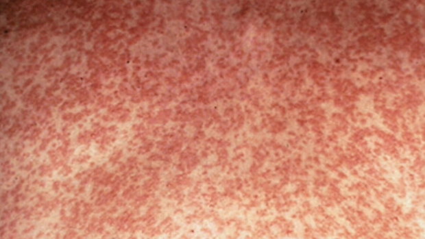 The tell-tale blotchy rash of a case of measles.