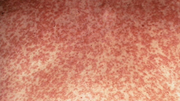 Measles forms a blotchy rash that starts at the neck and head and spreads down.