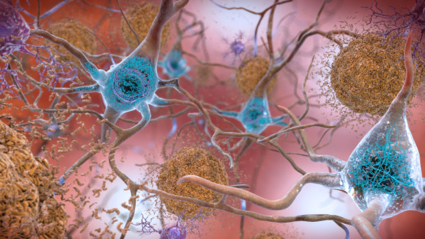 Abnormal levels of beta-amyloid protein form plaques (brown) that disrupt cell function and abnormal levels of tau protein form tangles (blue) harming communications between neurons in an Alzheimer’s affected brain.