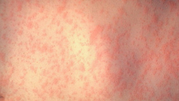 An alert by Queensland Health has warned of two measles cases in Brisbane's south.