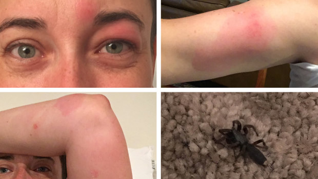 The extensive swelling was the tell-tale sign of another spider bite.