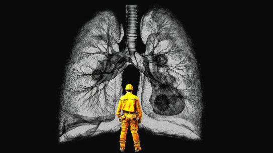 silicosis