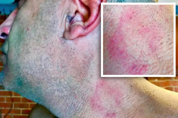 Marks left on the neck Greg Sposaro, who says he was assaulted by a police member in his own front garden.