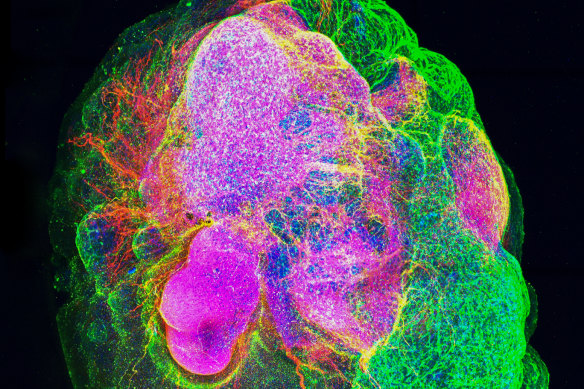 An example of a brain “organoid” – a bundle of human tissue grown in the lab from stem cells. Researchers from Queensland studied organoids to screen drugs that can flush out damaging “zombie cells” from brain tissue.