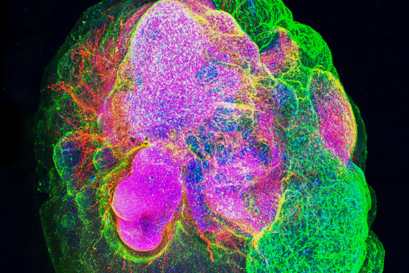 An example of a brain “organoid” – a bundle of human tissue grown in the lab from stem cells. Researchers from Queensland studied organoids to screen drugs that can flush out damaging “zombie cells” from brain tissue.
