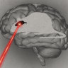 Why aren’t there any good medical treatments for a stroke?