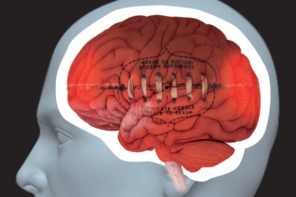 CTE is now linked to Parkinsonism.