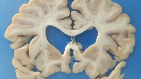 CTE brain