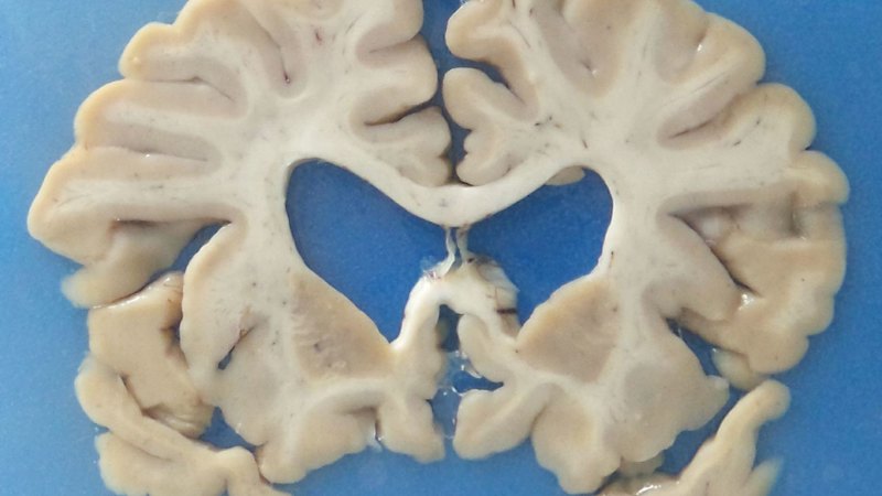 CTE is a frightening thing. But banning risky sports isn’t the answer (australia) — SMH