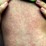 Measles cases on track to a five year high