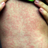 ‘Concerning’ rise in measles cases as travellers import virus