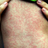 Measles alert after infectious baby flew from Manila, went to Central Coast