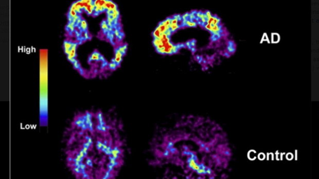 Scans of an Alzheimer's sufferer.