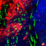 Tissue-resident memory T cells (in green) are pictured watching over melanoma cells (in red).