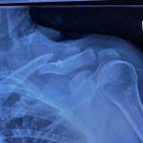 Kerri-Anne Kennerley’s X-ray reveals the broken collarbone after her dramatic fall.