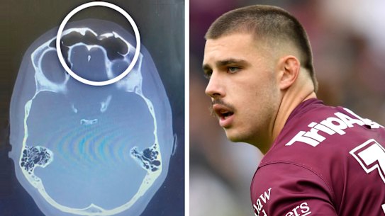 A scan showing the extent of Zac Saddler’s injury after his skull caved in.