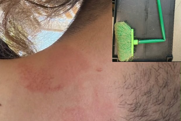 A red mark can be seen on a youth detention worker’s neck, reportedly caused by contact with a broom.