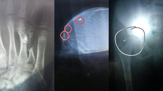 X-Rays that show the medical condition of Hodan Abby’s nine-year-old daughter. 
