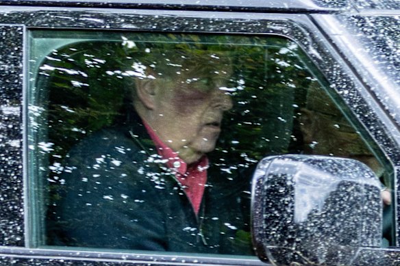 Andrew Mountbatten-Windsor è stato avvistato alla guida con un grosso livido sulla guancia destra.