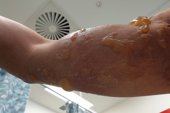 Wang was badly burnt in a workplace accident at a meatworks.