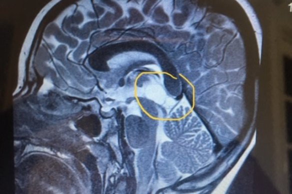 The 22mm Symptomatic Pineal Cystic tumour in Ella's brain. 