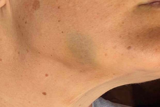 A bruise to a youth detention worker’s jaw.
